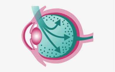 Intravitreal injection